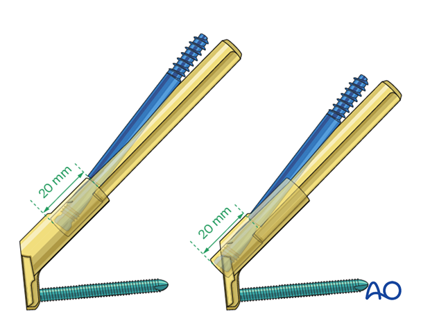 Femoral neck system with maximal sliding capacity