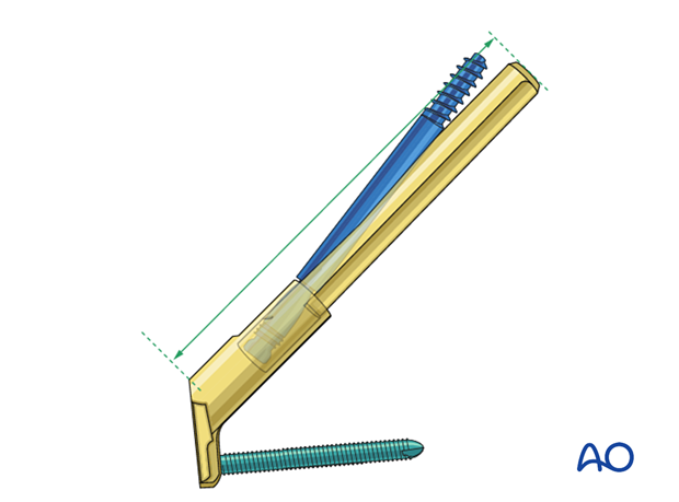 Femoral neck system and the overall implant size