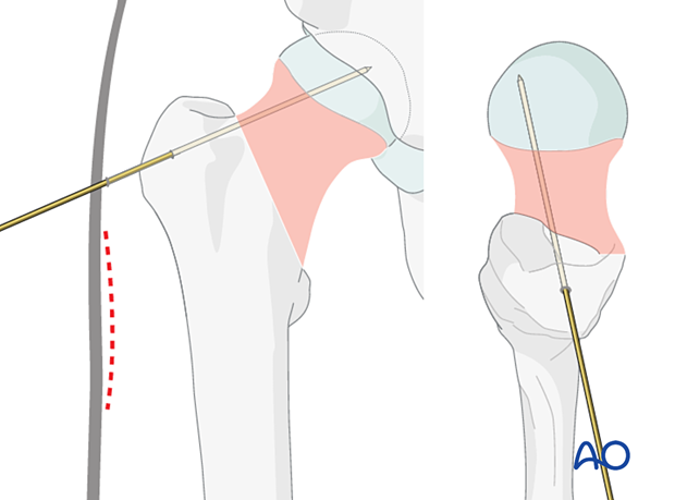 Insertion of an antirotation wire to prevent displacement during fixation of a femoral neck fracture with a femoral neck system