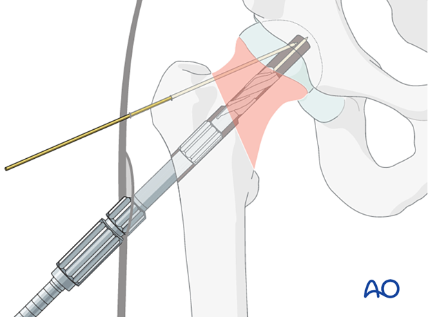 Reinsertion of the guide wire with the aid of the triple reamer during fixation of a femoral neck fracture with the femoral neck system