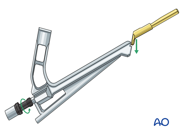 Attaching the femoral neck system implant to the insertion handle of the femoral neck system