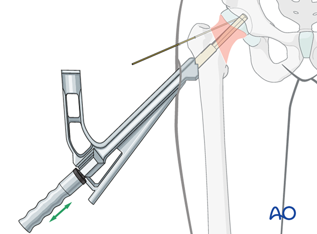 Tapping the implant of the femoral neck system into position