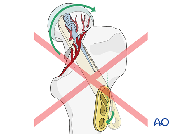 Rotation of the femoral neck system after insertion of the antirotation screw will disrupt the blood supply to the femoral head.