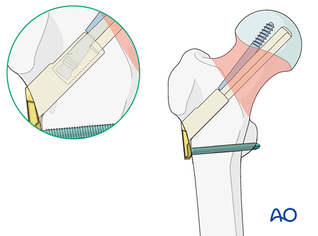 Femoral neck fracture fixed with a femoral neck system