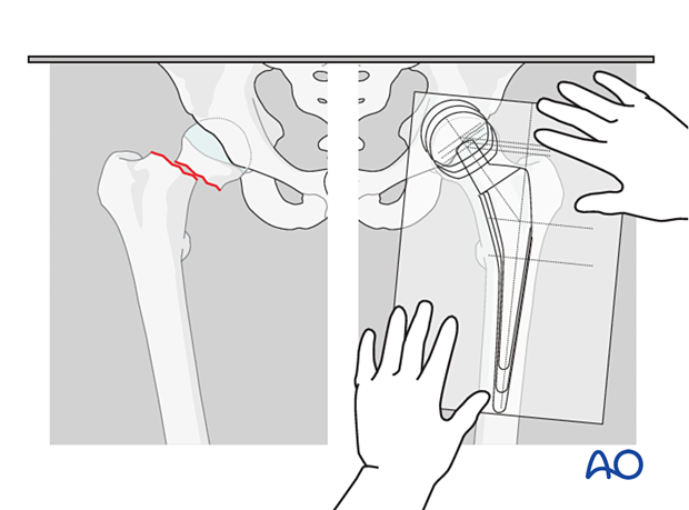 Preoperative planning for hemiarthroplasty of the hip