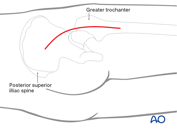 Posterior approach for arthroplasty of the hip