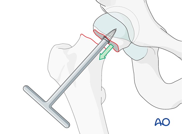 Removal of the femoral head with a threaded handle