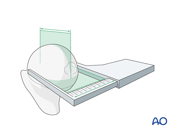 Determining the size of the head component by measuring the removed femoral head