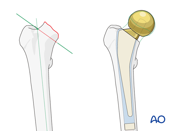 Osteotomy of the femoral neck for stem insertion