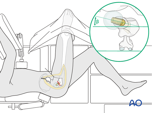 Correct prosthesis anteversion, using an anterolateral or lateral approach, with the patient in the lateral decubitus position