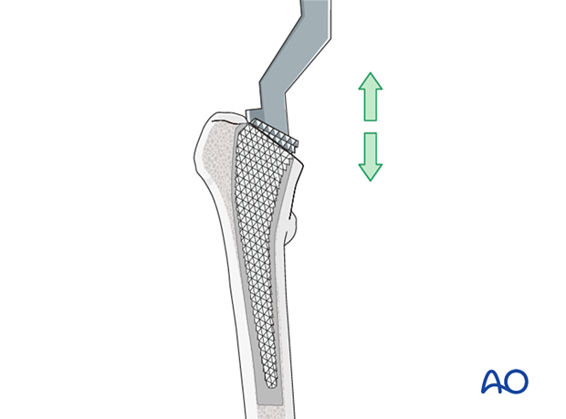 Broaching the medullary canal of the femur for arthroplasty of the hip