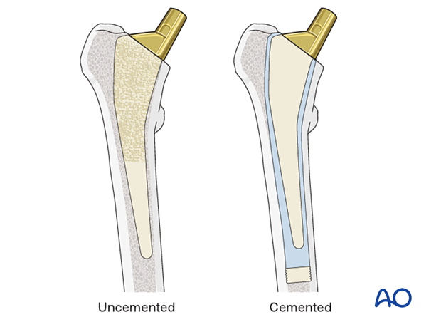 Uncemented and cemented stem for hip prosthesis