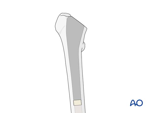 Broached medullary canal of the proximal femur with cement restrictor