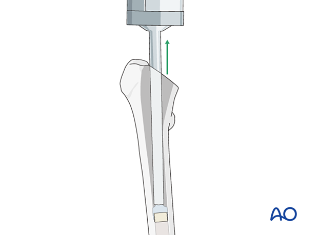 Insertion of cement into the medullary canal of the proximal femur