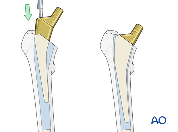 Stem insertion of the hip prosthesis