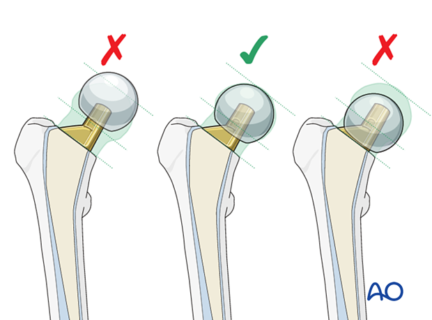 Selection of correct head component of the hemiprosthesis with trial heads