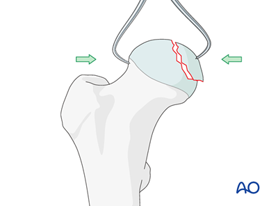 ORIF - Mini-fragment or headless screws for Split fractures of the ...