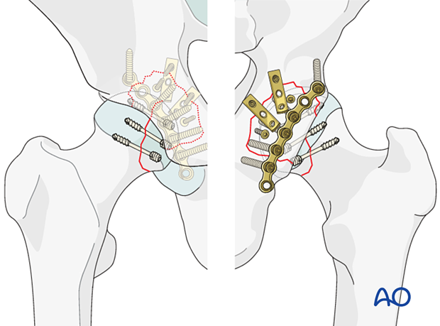 ORIF of a femoral head split and posterior wall fracture of the acetabulum