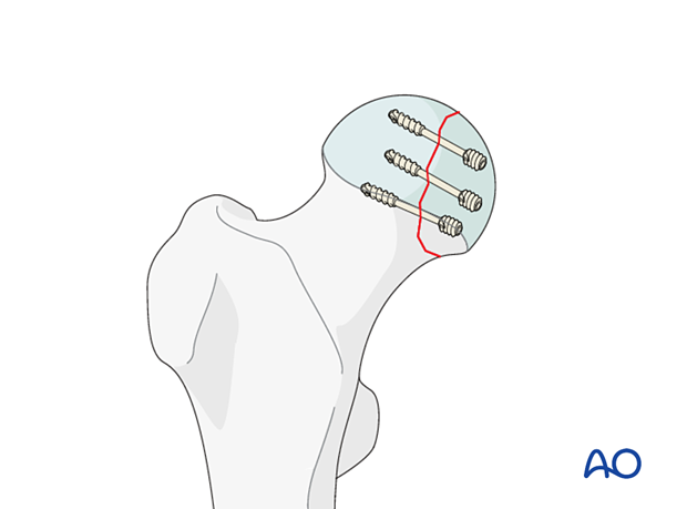 Femoral head split fracture stabilized with headless screws