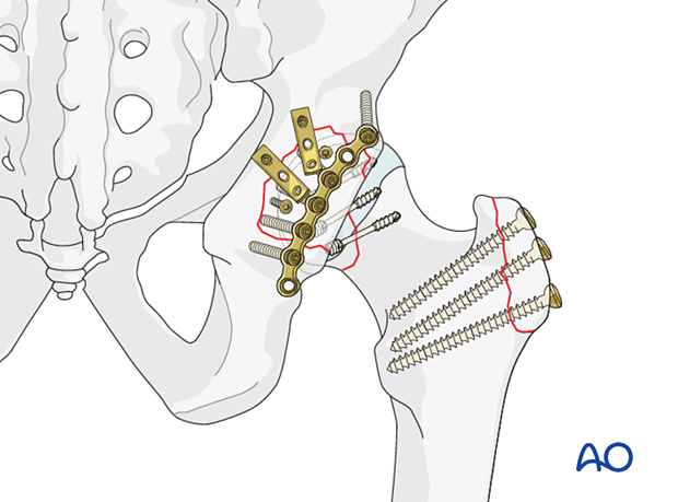 ORIF of a femoral head split and posterior wall fracture of the acetabulum and screw fixation of a trochanter osteotomy