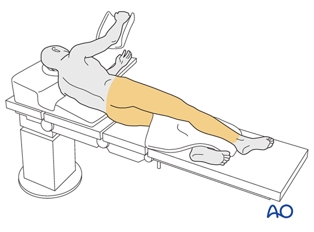 Patient in a lateral decubitus position with the skin disinfected for surgical treatment of proximal femoral fractures