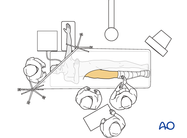 Operating room set-up with the patient supine on a radiolucent table for surgical treatment of proximal femoral fractures