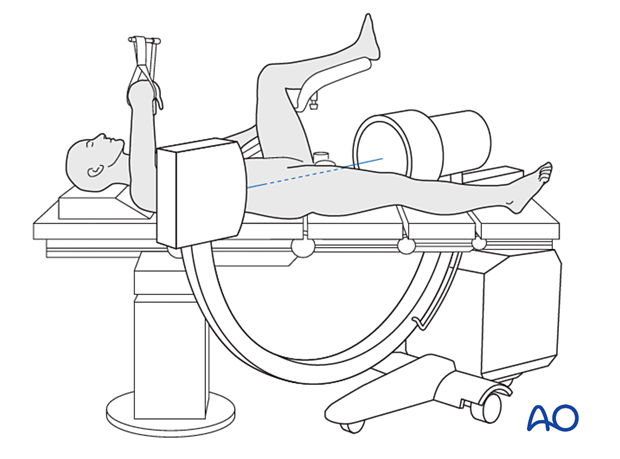 Supine patient position on a radiolucent table with the contralateral leg in a leg holder and the C-arm positioned for a lateral view of the proximal femur