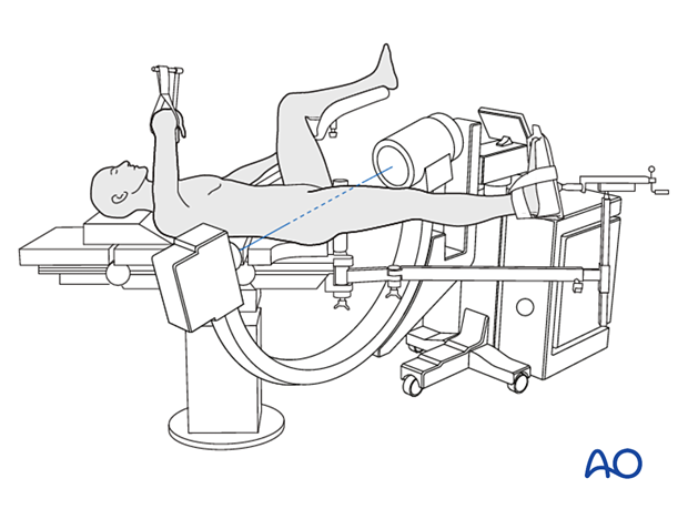 Supine patient position on a fracture table with the contralateral leg in a leg holder and the C-arm positioned for an axial view of the proximal femur