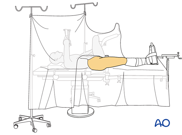 Skin disinfection and free draping of a patient position on a fracture table with the contralateral leg in a leg holder for surgical treatment of proximal femoral fractures