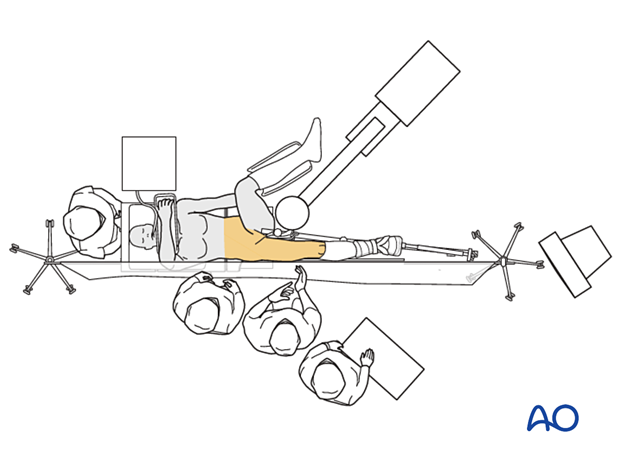 Operating room set-up with the patient supine on a fracture table for surgical treatment of proximal femoral fractures