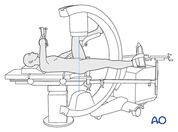 Supine patient position on a fracture table with the contralateral leg in a leg holder and the C-arm positioned for an AP view of the proximal femur