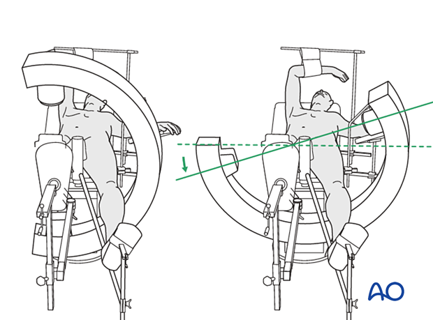 C-arm position to take AP and lateral views of the proximal femur with the patient supine on a traction table and the legs in scissors position