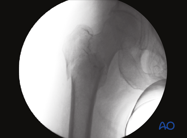 AP view of a trochanteric fracture