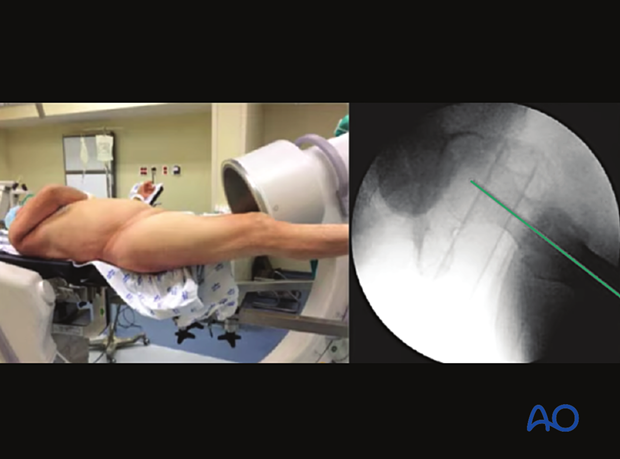 Patient and C-arm position and axial view of the proximal femur