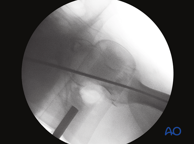 The axial view confirms correct placement of the guide wire for intramedullary nailing through the greater trochanter into the medullary canal of the femoral shaft.