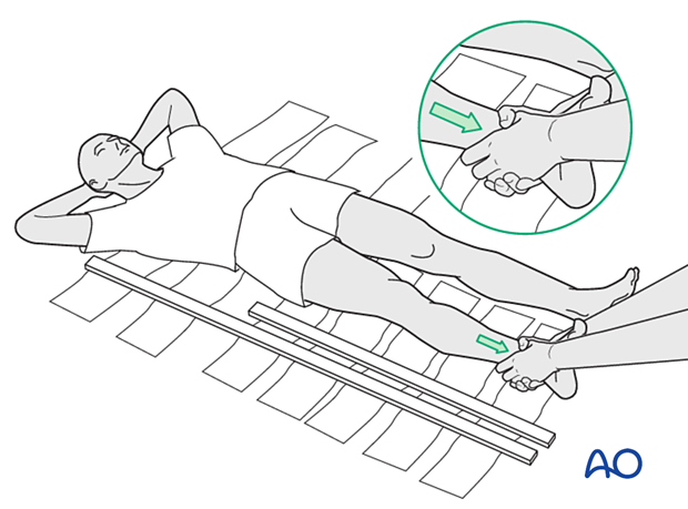 Splinting the whole leg for femoral fractures