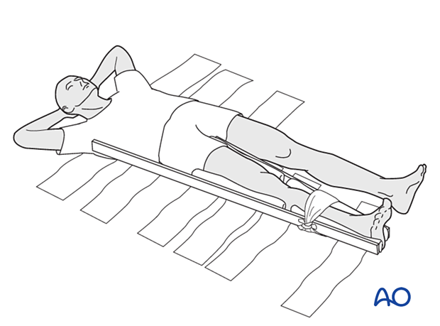 Splinting the whole leg for femoral fractures