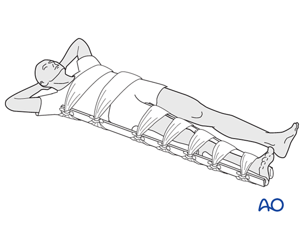 Splinting the whole leg for femoral fractures