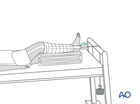 Straight skin traction with weight over the end of the bed for preliminary treatment of femoral fractures