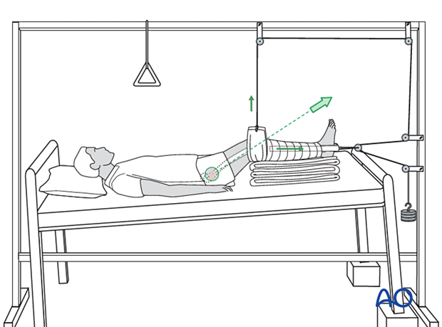 Balanced skin traction (Hamilton-Russell) of proximal femoral fractures with a mobile Balkan beam frame allowing for a slightly flexed knee and hip and elevation of the extremity