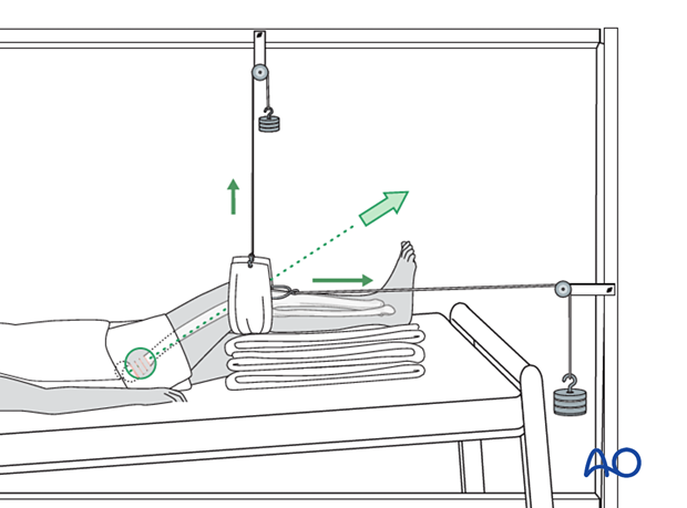 Skeletal traction of the leg with two cord-and-pulley systems on a Balkan beam