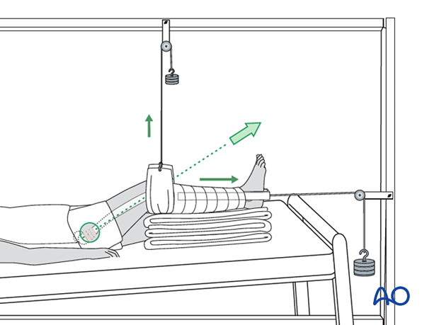 Balanced skin traction (Hamilton-Russell) of proximal femoral fractures with a mobile Balkan beam frame allowing for a slightly flexed knee and hip and elevation of the extremity with two separate pulley systems