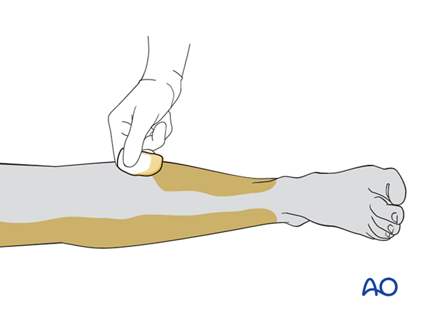 Skin preparation with tincture of benzoin before application of skin-traction kit to the lower leg