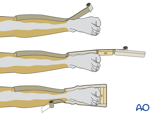 Application of skin-traction kit to the lower leg 