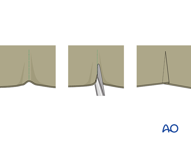 Creased area of adhesive bandage should be lifted and partially slit transversally, and the edges overlapped.