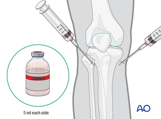 Local anesthesia to the pin insertion sites for application of the skeletal traction device 