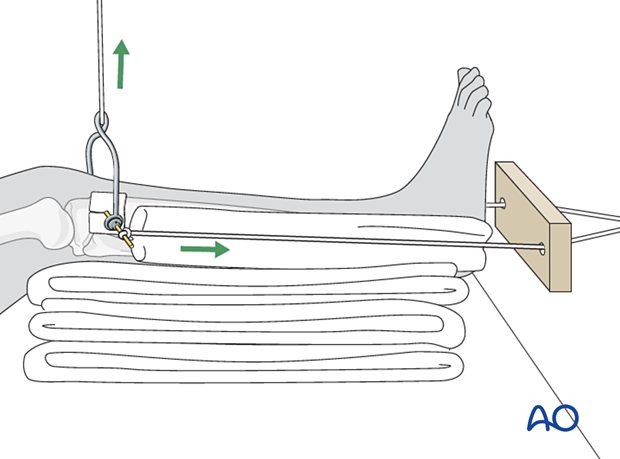 Skeletal traction of the leg with two cord-and-pulley systems 