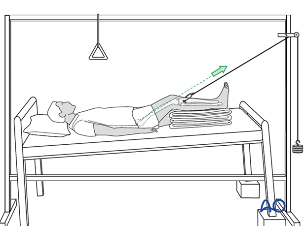 Skeletal traction of the lower limb through a proximal tibial pin with a mobile Balkan beam frame for treatment of proximal femoral fractures