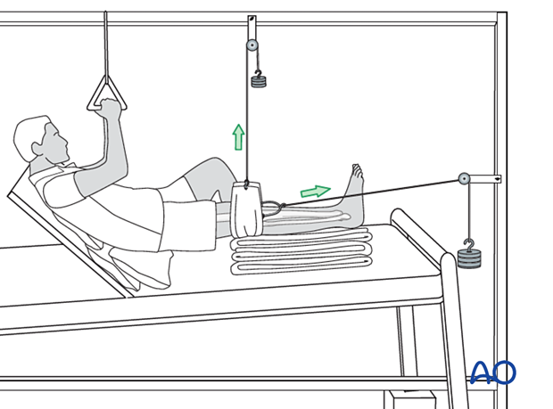 Patient mobilization during skeletal traction of the lower limb