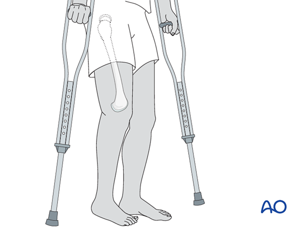 Weight-of-the-leg weight bearing with crutched for mobilization after treatment of proximal femoral fracture with traction